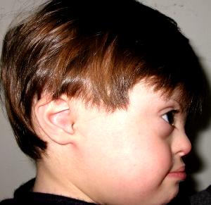 Downův syndrom (47,XX/Y, +21) incidence 1: 600-800 při narození: hypotonie, šikmé oční štěrbiny, nucheální řasa, anomálie uší, ploché záhlaví, palmární rýha, epikantus (vnitřní koutek), srdeční vady,