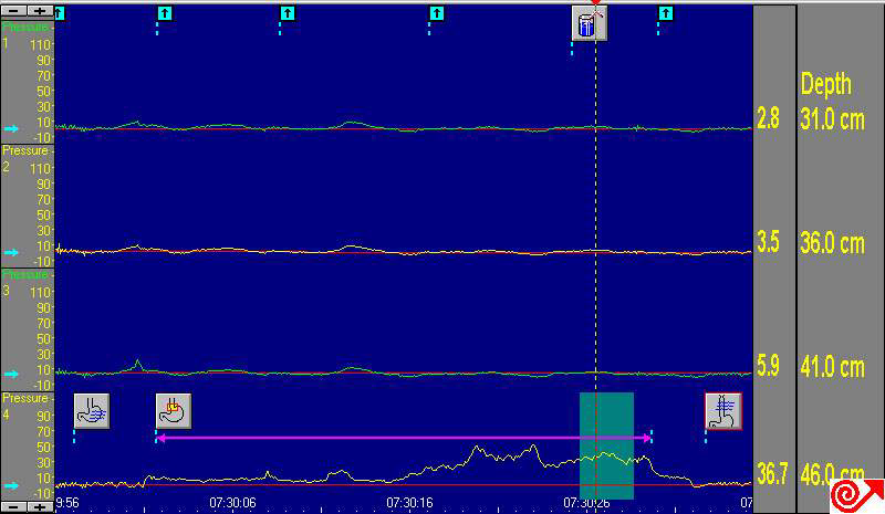 Fig. 4. Peroperative manometry of esophagus after myotomy was performed.