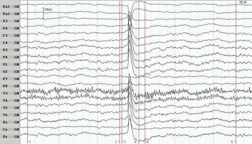 Artefaktů může být celá řada a je nutné je při analýze EEG záznamu eliminovat.