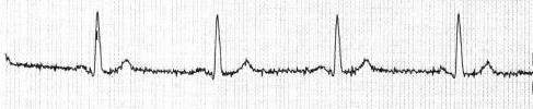 4. Puls (tep) Jelikož je hlavní měření doprovázeno sekundárním měření tepové frekvence, je nutné uvést základní teoretické poznatky o této oblasti pro lepší porozumění naměřených hodnot. 4.