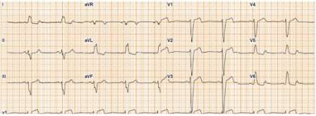 Návrh nové definice LBBB QRS > 140 ms u mužů, 130 ms u žen QS n. rs V1, V2 notching n.