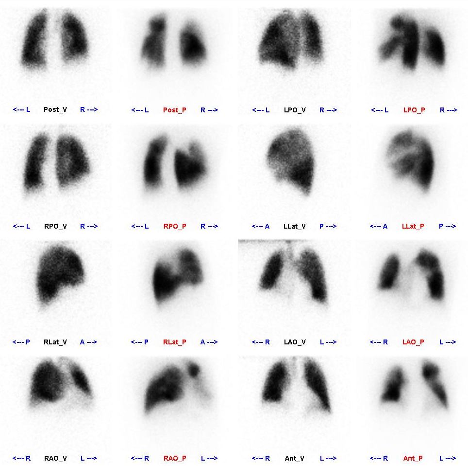 Obr. Perfúzno - ventilačná scintigrafia pľúc, porovnanie ventilácie (obrázky s červeným popisom) a perfúzie (obrázky s čiernym popisom) VYŠETRENIE OBLIČIEK Statická scintigrafia Statické scintigramy