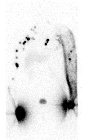 Obr. Rádionuklidová venografia 99m Tc MAA - diagnostika žilovej trombózy na DK - pozitívny nález Scintigrafické zobrazenie trombov pomocou Tromboscintu sa využíva na celotelové zobrazenie žilovej