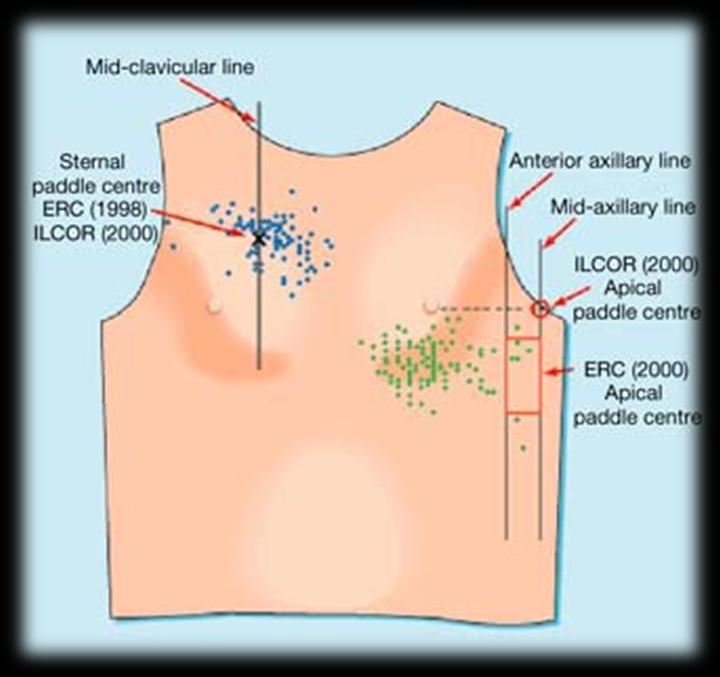 Defibrilace II. Poloha elektrod (90% lékařů nesprávně) Preferováno používání samolepících pads Perkins GD et al.