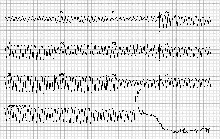 Flutter komor ukončený defibrilací komplexy tvaru sinusoidy, fr.