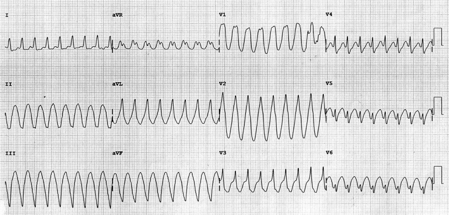 Hemodynamicky dobře tolerovaná komorová tachykardie u nemocného s idiopatickou komorovou tachykardií (na pulzním oximetru vidíme velice kvalitní křivku). Nemocný vnímal pouze palpitace.