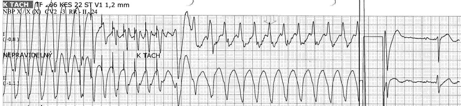 Nicméně v tomto nálezu jsou krásně patrné hrotu QRS komplexů, v intervalech, které odpovídají sinusovému rytmu před