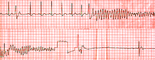 QT interval a Torsade de pointes Norma QTc u mužů < 0,44 u žen < 0,46 BONUS NEFARMAKOLOGICKÁ LÉČBA Nález může