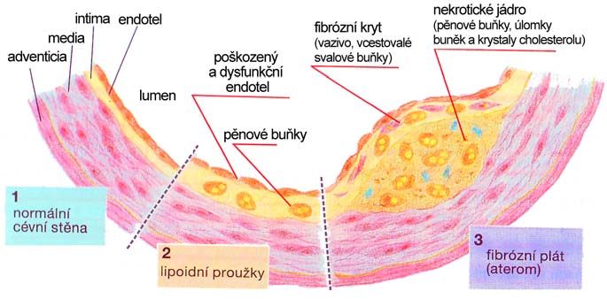 2.2. Arteroskleróza Ateroskleróza, je pomalu postupující onemocnění tepen, při kterém dochází k usazování fibrózních uloženin do cévní výstelky - intimy.