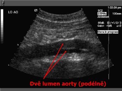 Příloha č. 8 Sonografické zobrazení břišní aorty zdroj: www.stefajir.