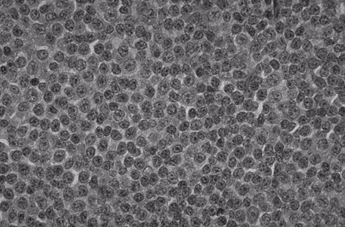 Lymfomy Hodgkin's disease maligní proliferace lymfatické tkáně (uzliny) bb.