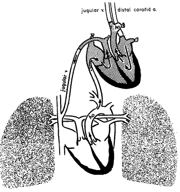 2 HISTORIE TRANSPLANTACE SRDCE Transplantace srdce je dnes již běžně klinicky užívanou metodou léčby pacientů s těžkým srdečním selháním.