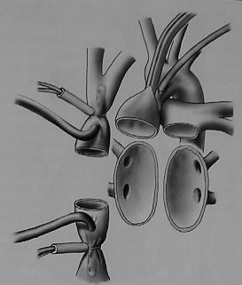 odstraňuje celá pravá síň a z levé síně se ponechají dva terčíky, spojujících na každé straně ústí dvou plicních žil (Obr. 16).