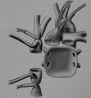 Obr. 17 Bikavální ortotopická transplantace srdce (Aschermann et al., 2004) Po odstranění nemocného srdce bikavální technikou se do zbytku levé síně zavede vent k odsávání krve přitékající z plic.