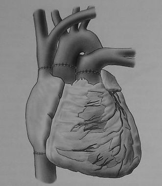 Obr. 18 Schéma dokončené transplantace srdce (Aschermann et al., 2004) 5.3 Mimotělní oběh během transplantace srdce Během operace je pacient v celkové anestezii a je napojen na přístroj (Obr.