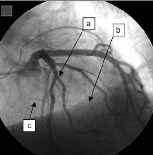 od transplantace srdce okolo 50% a v 5. roce dosahuje 100% (Rickenbacher et al., 1996).