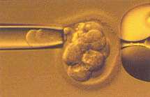 Odběr buňky z embrya Preimplantační genetická diagnostika však umožňuje odhalit řadu závažných odchylek v počtu chromozomů, které brání zdravému a správnému vývoji embrya.