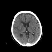 Akutní fáze ischemické cévní mozkové příhody diagnostika 1 1.