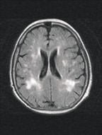 Akutní fáze ischemické cévní mozkové příhody diagnostika 1 