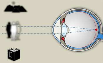 8. Sférické refrakční vady 8.1. Myopie (krátkozrakost) 8.1.1. Charakteristika myopie Myopie neboli krátkozrakost je sférická refrakční vada.