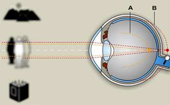 9. Asférické refrakční vady 9.1. Astigmatismus 9.1.1. Charakteristika astigmatismu Astigmatismus je asférická refrakční vada, kdy oko vykazuje ve dvou na sebe kolmých řezech různou refrakci. Obr.