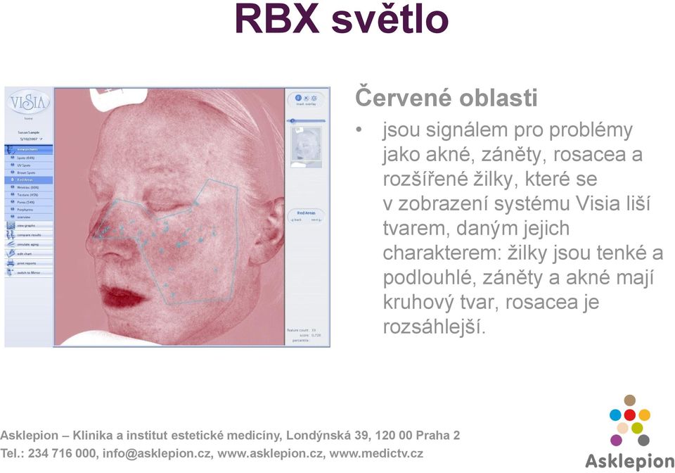 Visia liší tvarem, daným jejich charakterem: žilky jsou tenké a