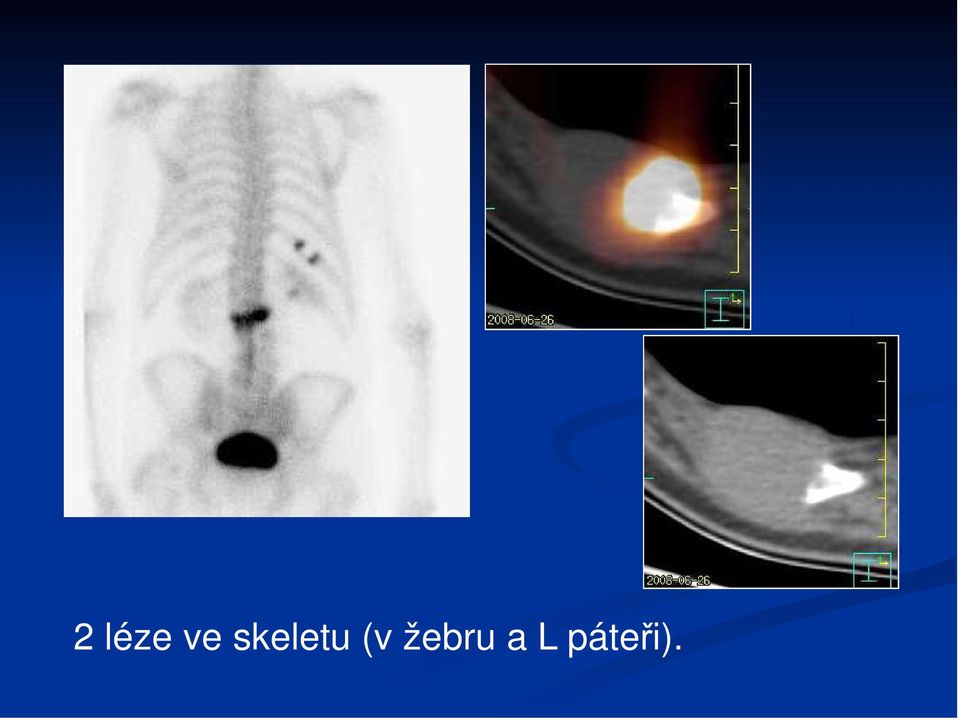 (v žebru