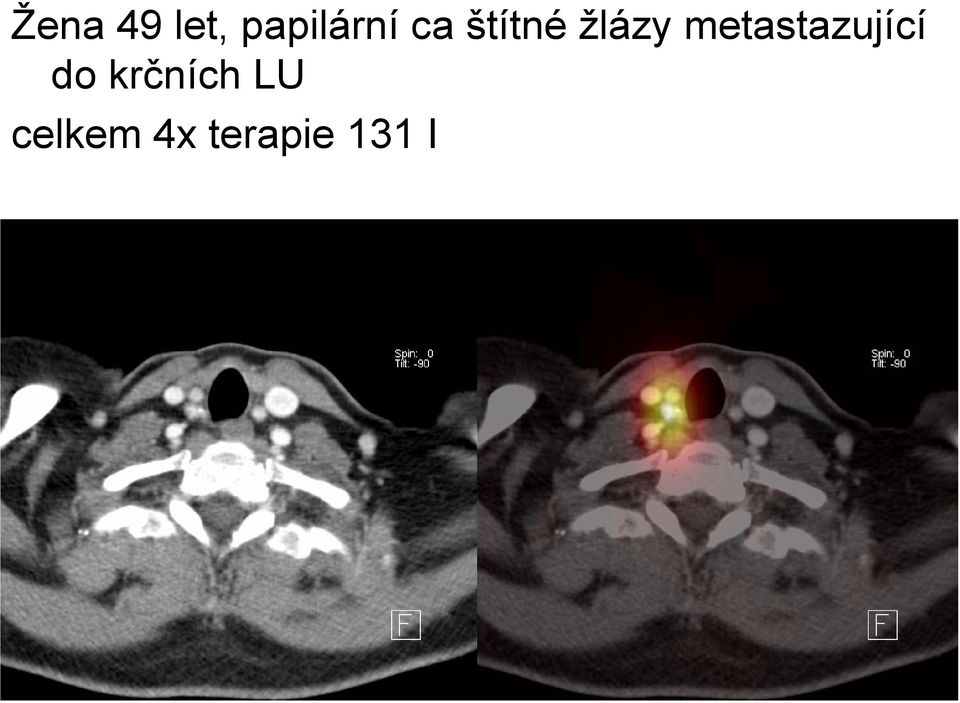 metastazující do