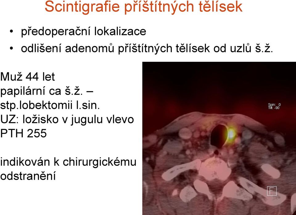 Muž 44 let papilární ca š.ž. stp.lobektomii l.sin.