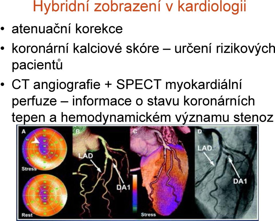 CT angiografie + SPECT myokardiální perfuze informace