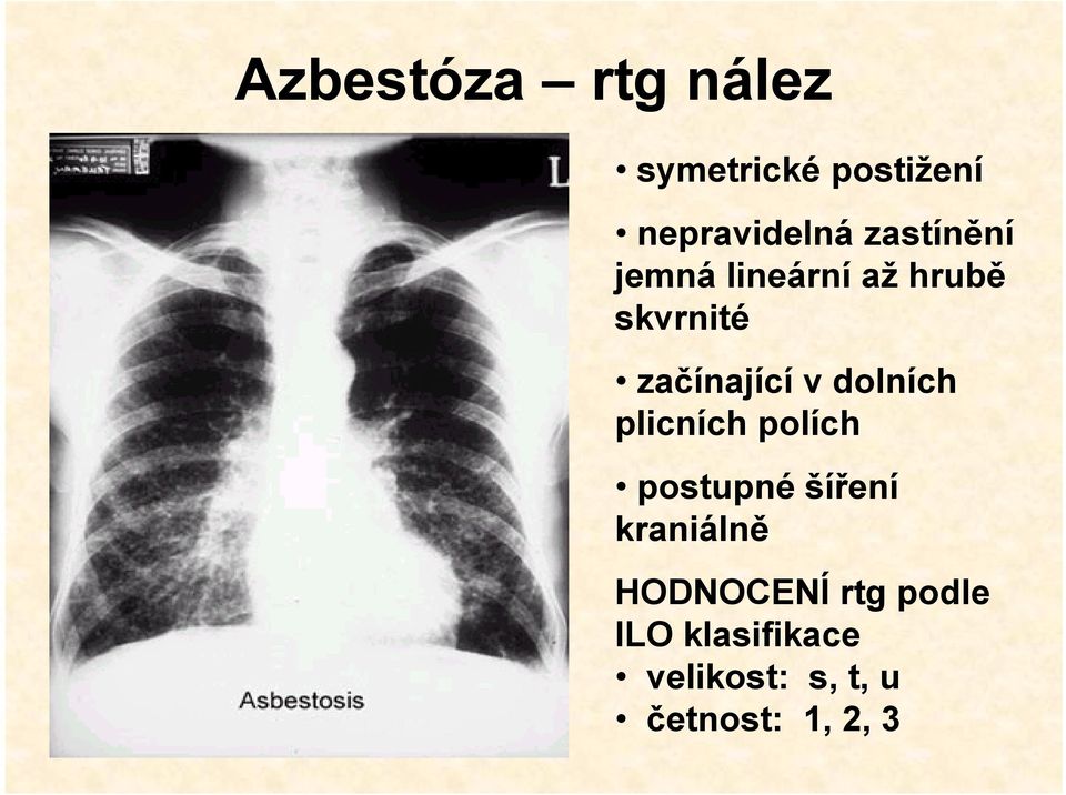 dolních plicních polích postupné šíření kraniálně