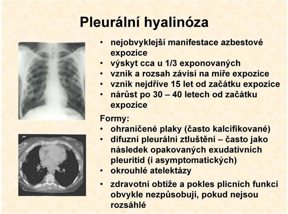 ohraničené plaky (často kalcifikované) difuzní pleurální ztluštění často jako následek opakovaných exudativních