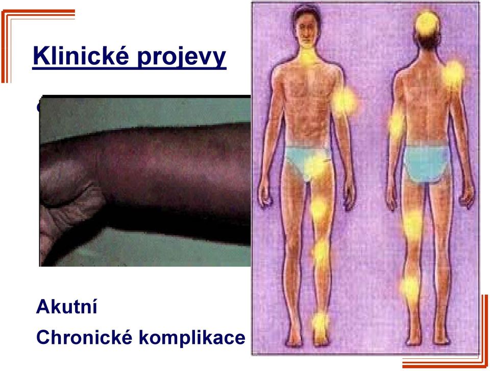 forma 1-5% Lehká forma > 5% 90 % příhod