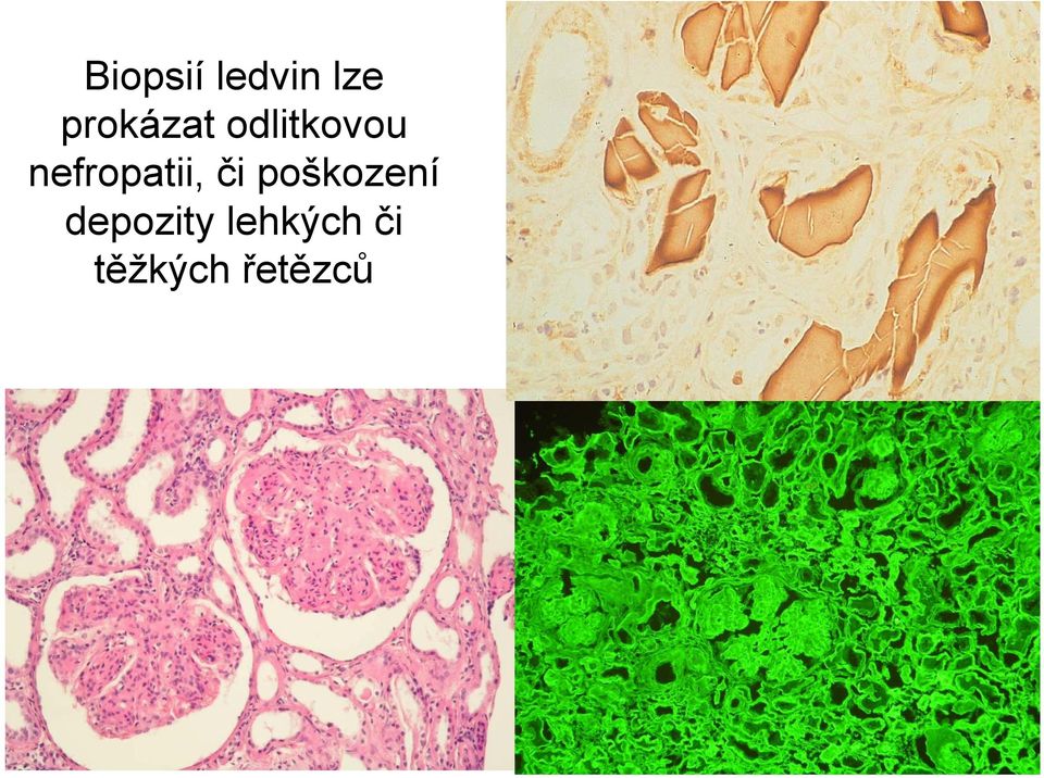 nefropatii, či poškození