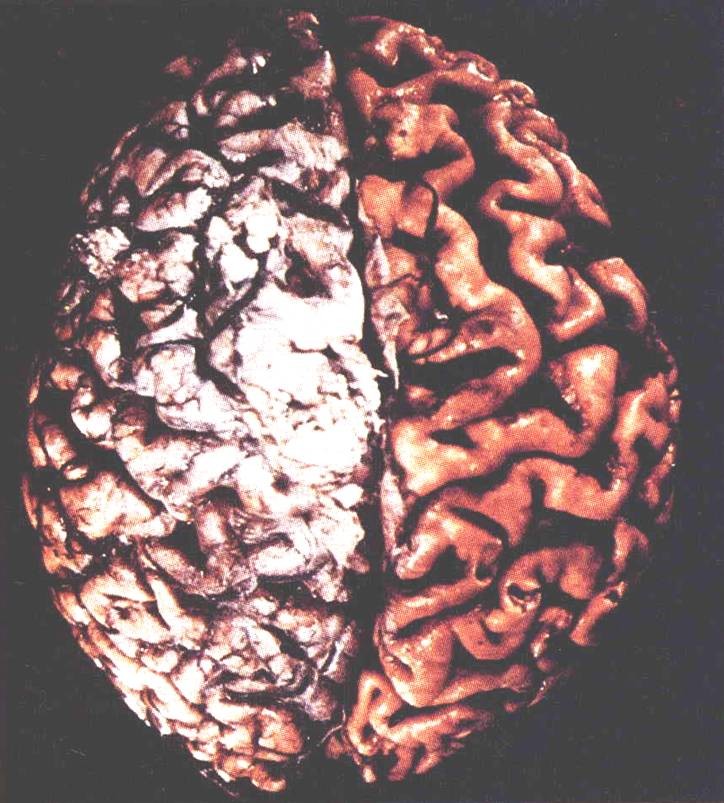 II. Alzheimerova nemoc (AN) MORFOLOGIE Klesá hmotnost a objem mozku