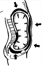 by vedlo k nedostatečné přední stabilizaci páteře a přetížení extenzorů (Kolář, 2006; Kolar et al., 2010).