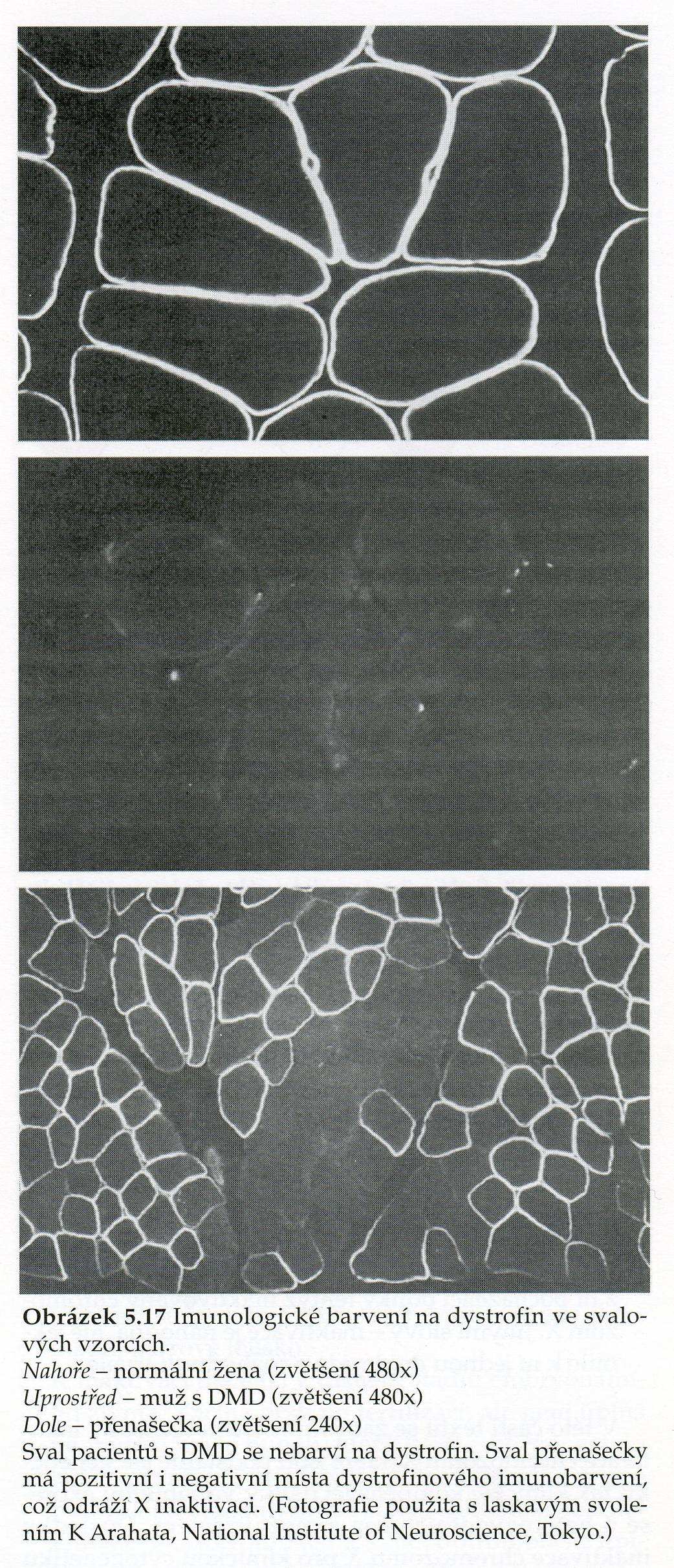 CHROMOSOM X důsledek inaktivace X chromosomu variabilita exprese X vázaných genů u žen heterozygotek (přenašeček genu pro X vázané onemocnění) Funkční mozaicismus v důsledku inaktivace X chromosomu,