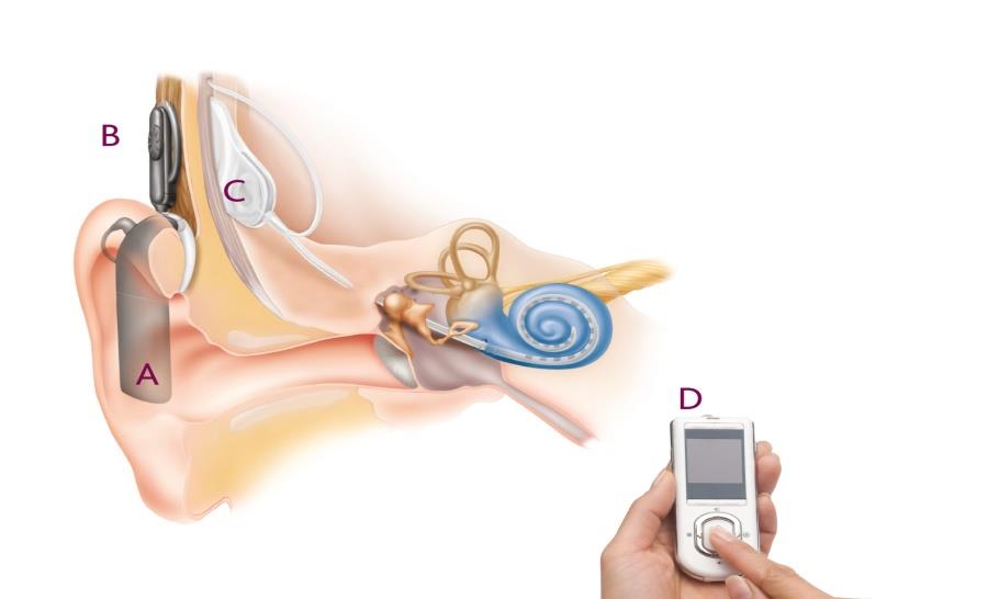 Obrázek č. 1. Kochleární implantát Nucleus 5 (http://www.cochlear.com) 2.4.