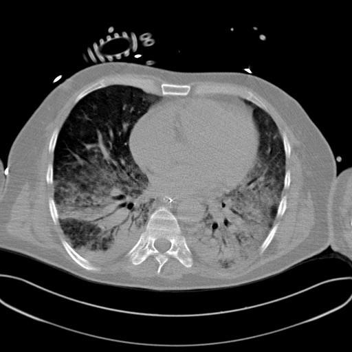 Neutropenie po Biseptolu Pneumonie -