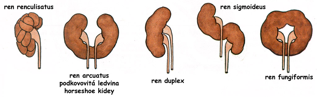 Vývojové vady ledvin ageneze ektopie (většinou