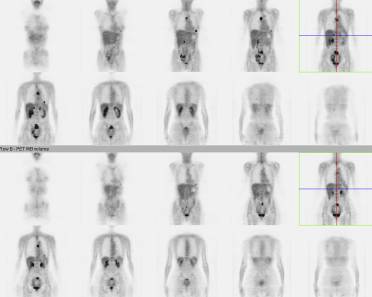 Studie u pacienta před a po léčbě. Fúze PET / CT a PET / MR.