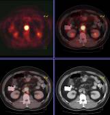 Příklad fúze PET / CT.