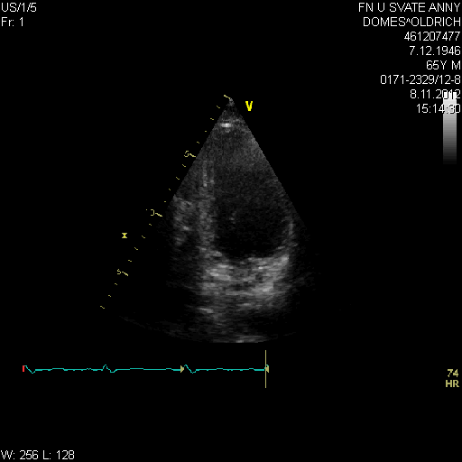 Difference between IH+ / IH- groups (in favor of IH+/ICM group) p NYHA 0.001 LVEF (%) 0.002 DD (mm) 0.