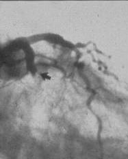 A Reminder of the Significance of Stent Thrombosis ST typically presents