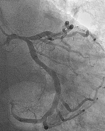 IVUS Distal LM EEMφ 6.2mm MLA 3.