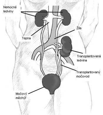 Obrázek 1: Schéma uložení transplantované ledviny v levé kyčelní jámě.