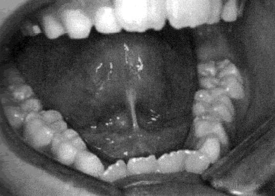 Mutismus (oněmění) je náhlá ztráta již vyvinuté řeči. Příčinou může být úlek, duševní úraz, velké vzrušení nebo totální vyčerpání. (Klenková 2000, s.