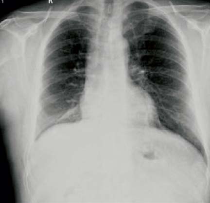 Kazuistiky s bronchioloalveolárními rysy gradientu I se zv enou hlenotvorbou a du nost klinického stadia T3NxM0.