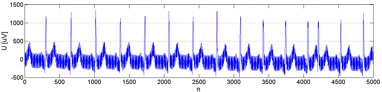 7. Návrhy pro filtraci brumu V podkapitole 7. se zabýváme ávrhem filtrů pro filtrací síťového rušeí, brumu o frekveci 5Hz. Na obrázku č.