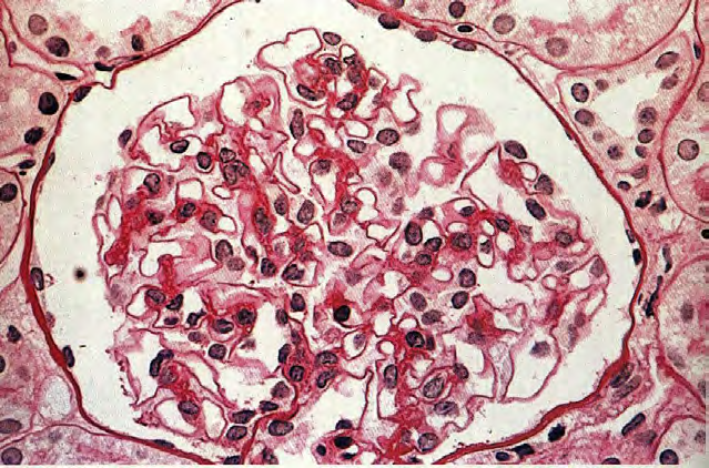 Světelná mikroskopie Morfologie může být velmi rozmanitá krescentní, membranozní, akutní